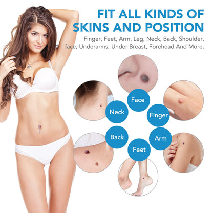 Automatic Skin Tag and Mole Removal Kit