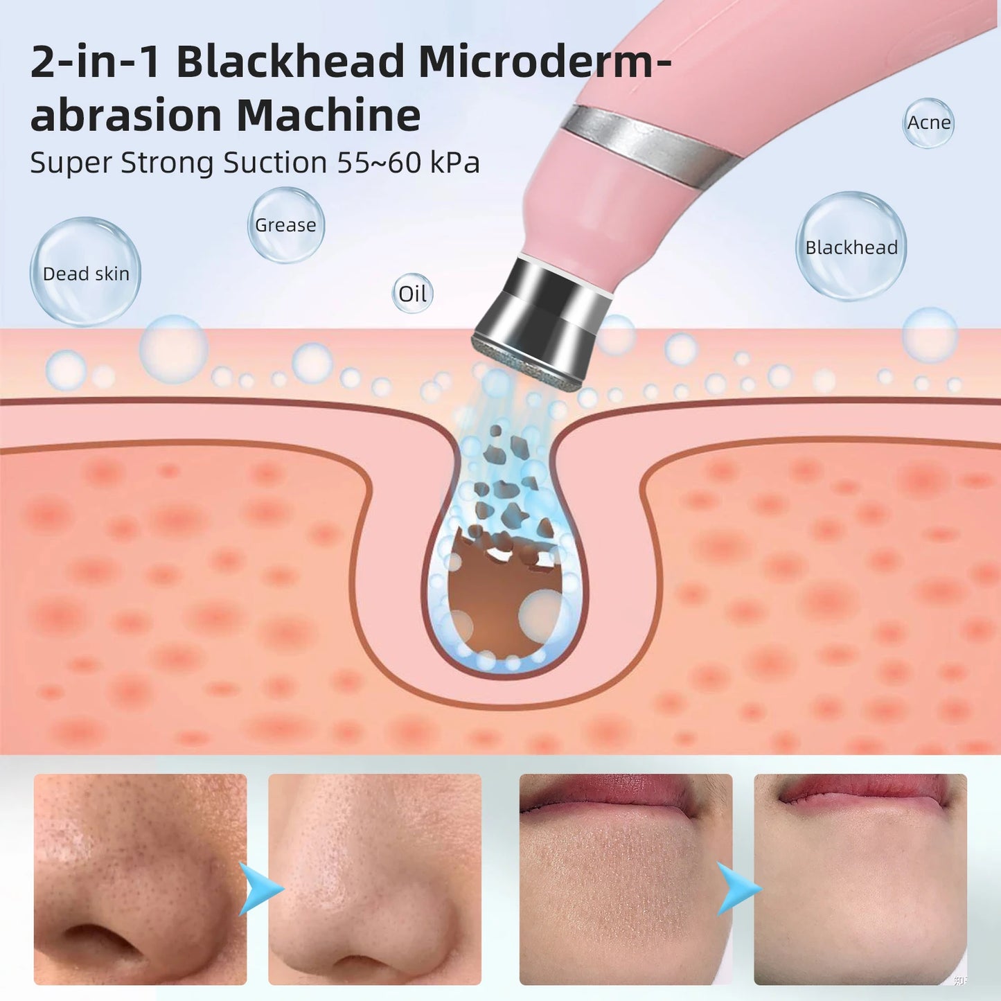 Portable Diamond Microdermabrasion Peeling Machine