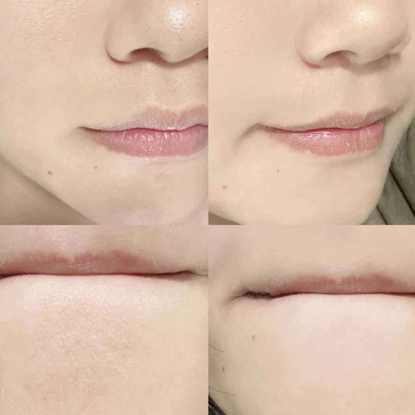 Stainless Steel Dual-Ended Blackhead Remover Tool