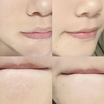 Stainless Steel Dual-Ended Blackhead Remover Tool