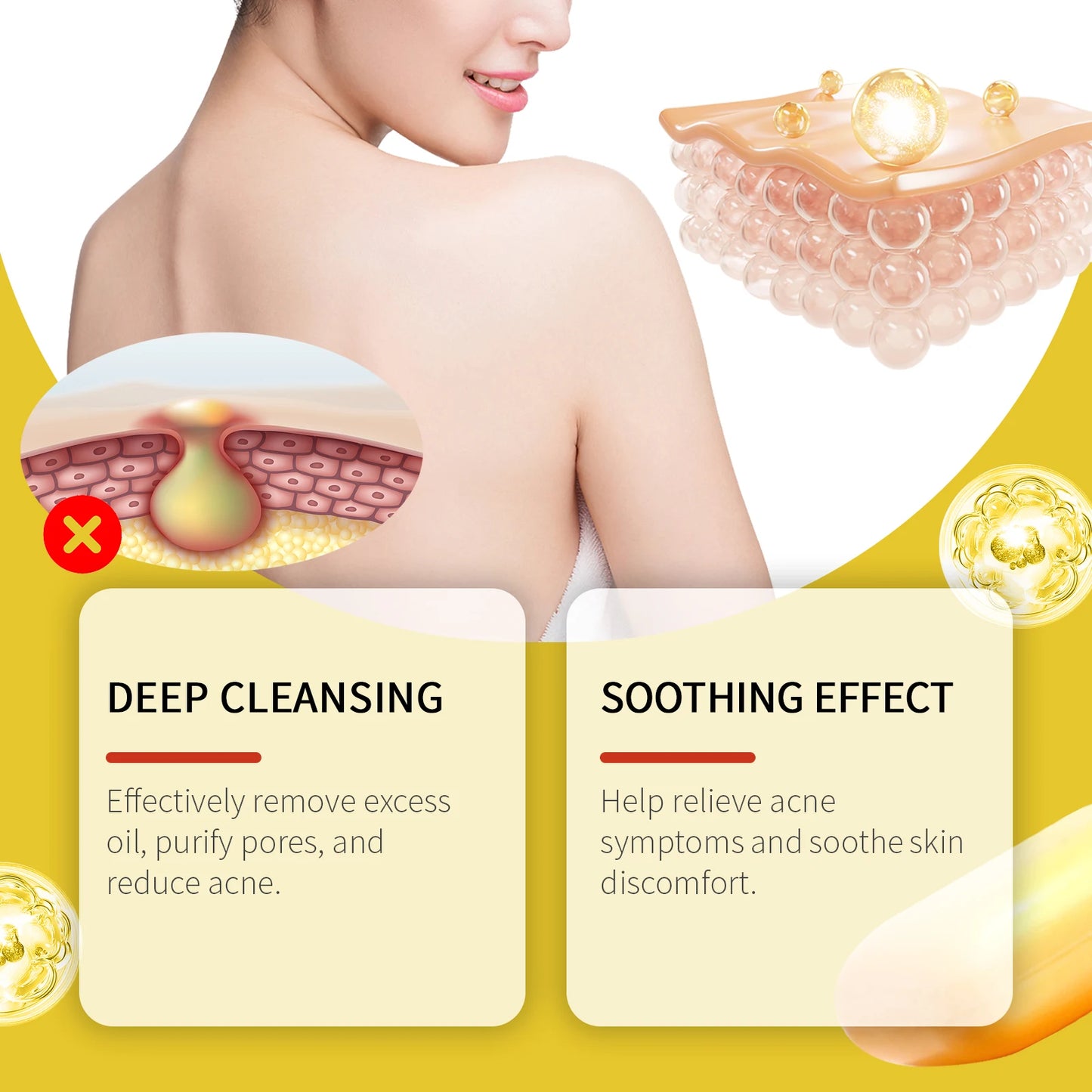 Acne-Control Cleansing Soap