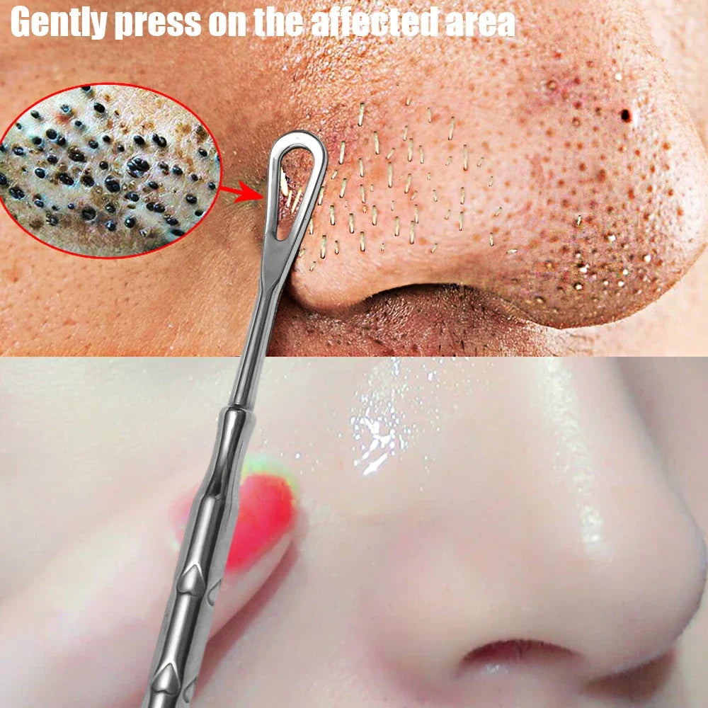 Blackhead Remover Pimple Popper Tool